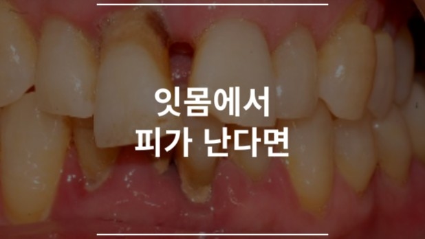 잇몸에서 피가 난다면