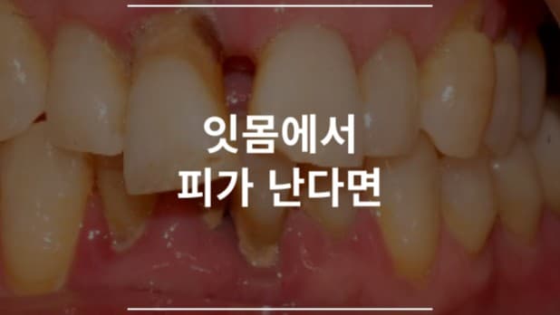 잇몸에서 피가 난다면